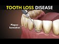 Periodontitis or Gum disease: 3d animation included