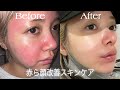 ガチの赤ら顔！365日肌荒れ女による敏感肌向けスキンケア