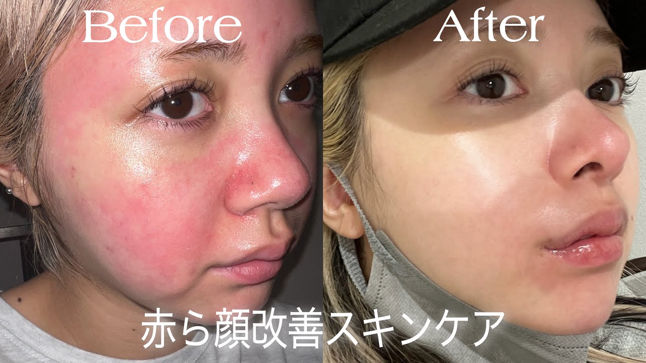 赤ら顔・肌荒れに】ヒミリジェル 高濃度水素ケア 8割残（定価¥33,000