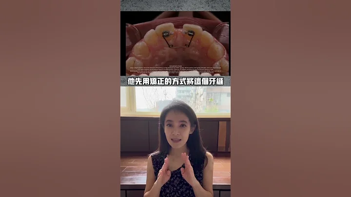 門牙縫很大怎麼關🤔#牙齒矯正#樹脂補牙 - 天天要聞