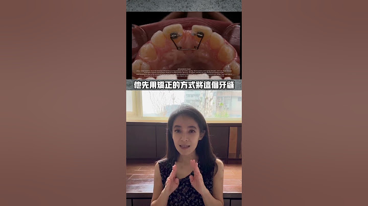 门牙缝很大怎么关🤔#牙齿矫正#树脂补牙 - 天天要闻