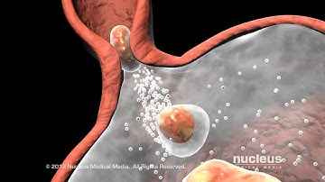 Nissen Fundoplication for Acid Reflux / Heartburn / GERD