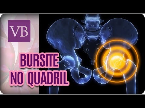 Vídeo: Bursite Da Articulação Do Quadril