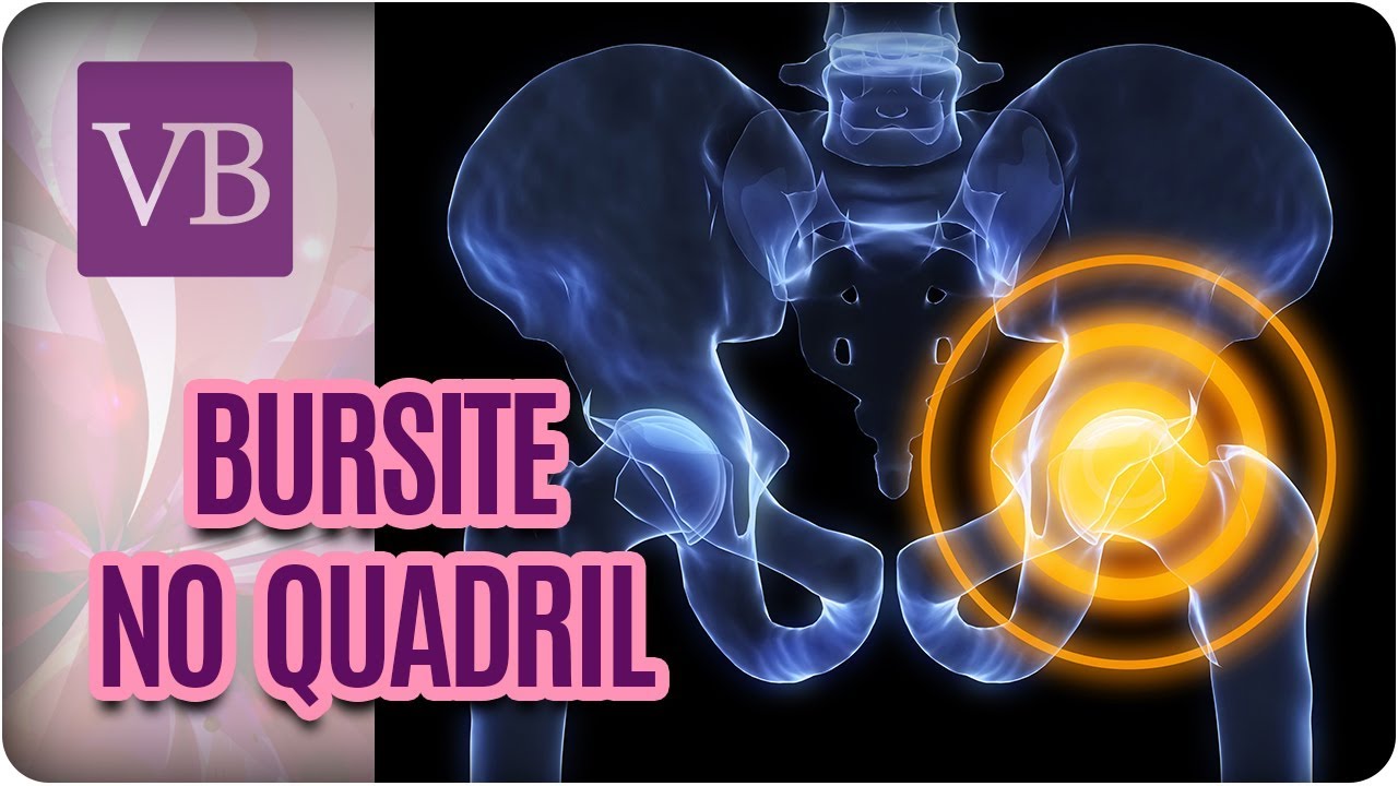 Bursite no Quadril: Dor e Inchaço no Quadril + Exercícios - Você Bonita (02/04/18) vida saudável herbalife