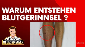 Wie kündigt sich ein Blutgerinnsel an?