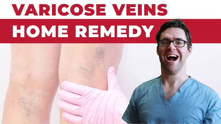 #1 Best Varicose Vein Home Remedies [Spider Veins in Legs Treatment]