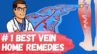 #1 Best Varicose Vein Home Remedies [Spider Veins in Legs Treatment] screenshot 4