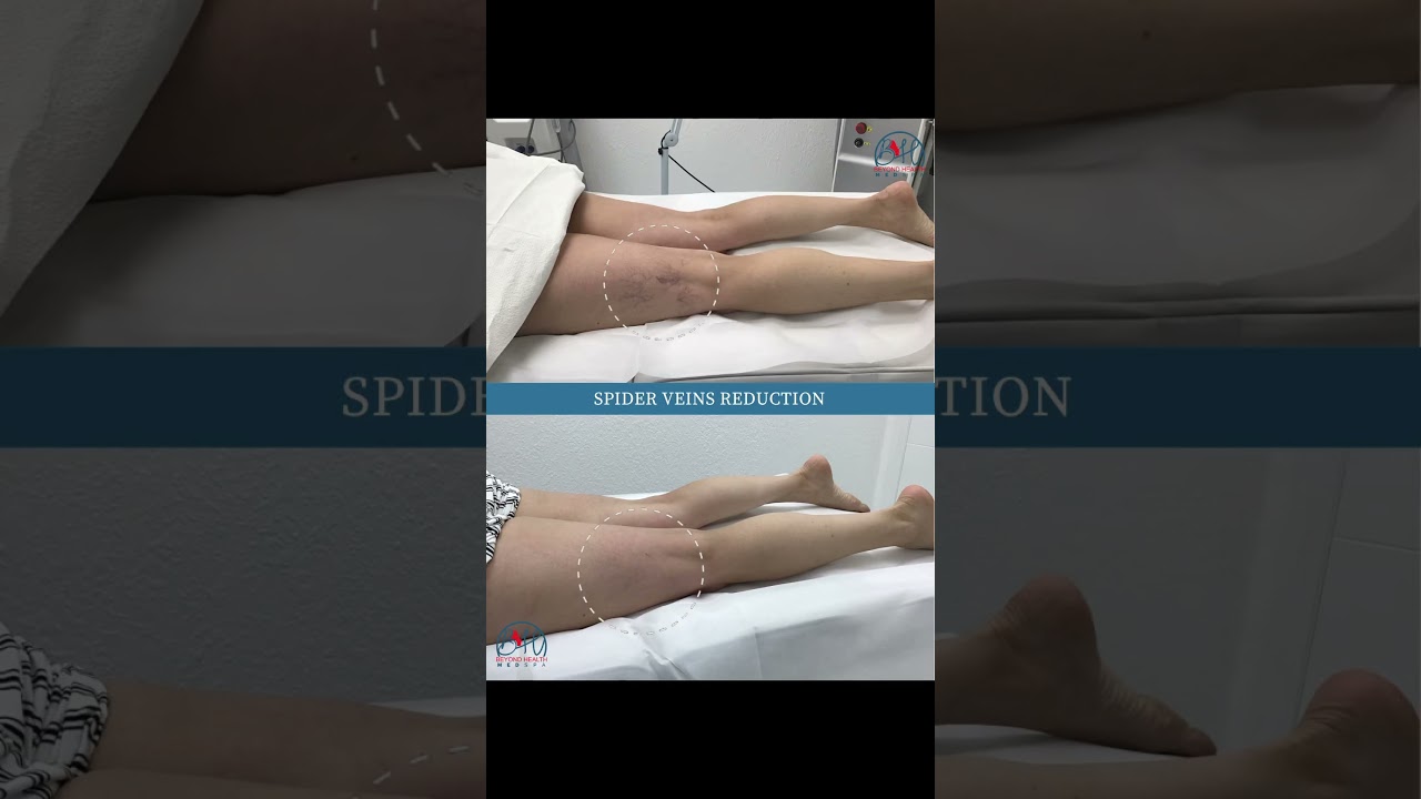 Still bothered by visible spider veins?