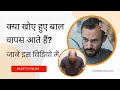 क य ख ए ह ए ब ल व पस आत ह Hair Loss Treatment Hair Fall Solution VHCA Hair Clinic