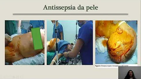Em que momento se inicia o intra-operatório?