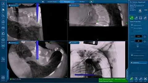 Medtronic O arm 3D Navigation guided OSTEOTOMY