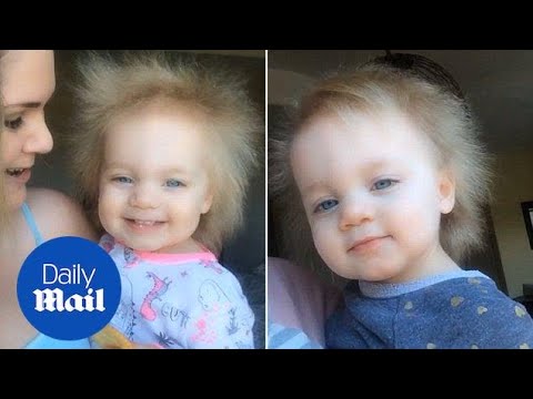 Baby has rare condition which gives her hair like Albert Einstein