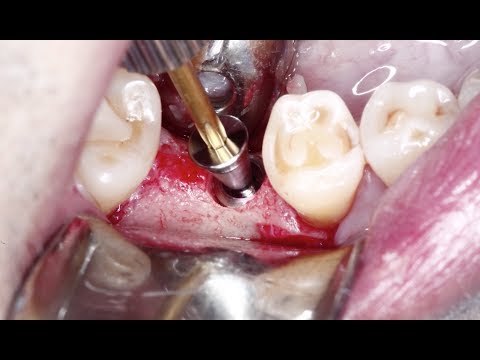 Video: Endosteal-implantti: Hammasimplanttityypit Ja -menetelmät