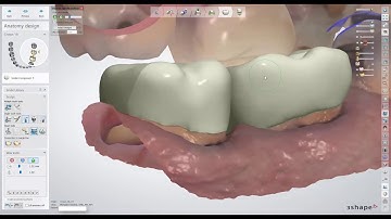 Patient Specific Motion & Digital Crown Design Using an Intraoral Scanner!!