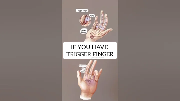 If you have Trigger Finger, try these two exercises #triggerfinger