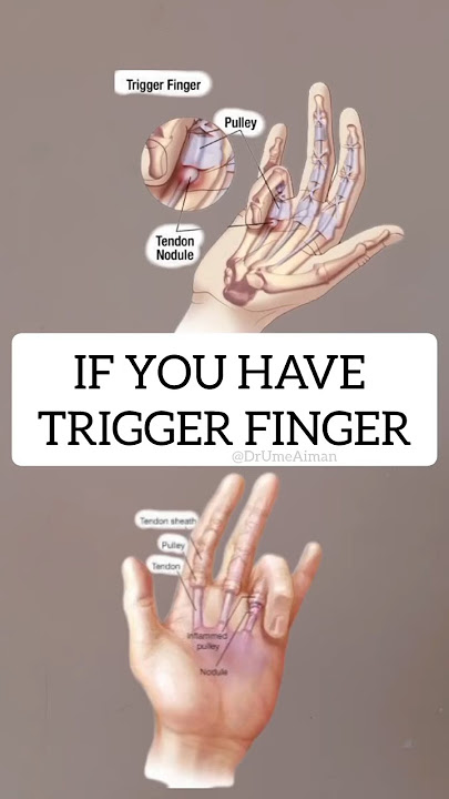 If you have Trigger Finger, try these two exercises #triggerfinger