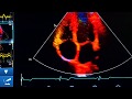 Tissue Doppler LV