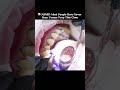 🦷 (ASMR) This Is What Happens Before Veneers Are Installed