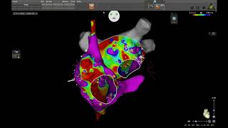 Persistent Atrial Fibrillation Catheter Ablation