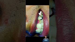 حشو تجميلي لناب علوي ||Composite restoration of canine teeth dr_abdullah_sultan_dentist