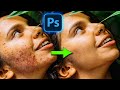 Remove EXTREME Acne with Ai Generative Fill in Photoshop (Beta)