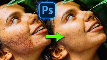 Remove EXTREME Acne with Ai Generative Fill in Photoshop (Beta)