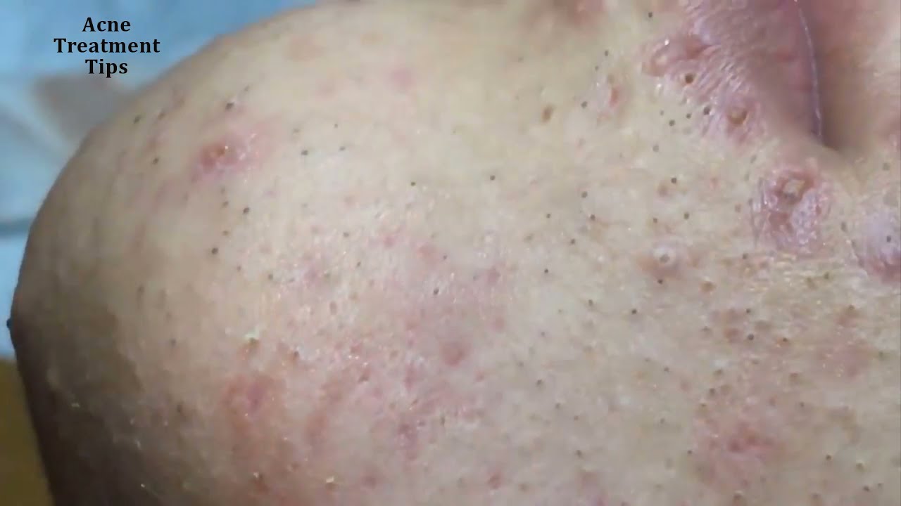 11 Acen Treatment Tips Teen boy with blackheads YouTube