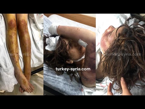 جريمة تهزالمجتمع السوري والتركي مواطن سوري يعذب زوجته بطريقة تقشعر الأبدان