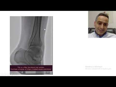 Ayak yaralarına yapılan balon işlemi amputasyonu(bacak kesilmesini) önleyebilir mi ?