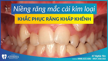 Niềng răng mắc cài kim loại - khắc phục răng khấp khểnh 3 | Nha khoa quốc tế Athena
