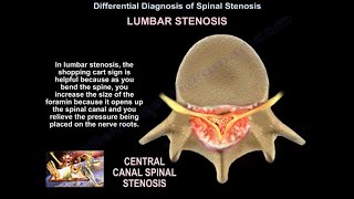 lumbar Stenosis - Everything You Need To Know - Dr. Nabil Ebraheim