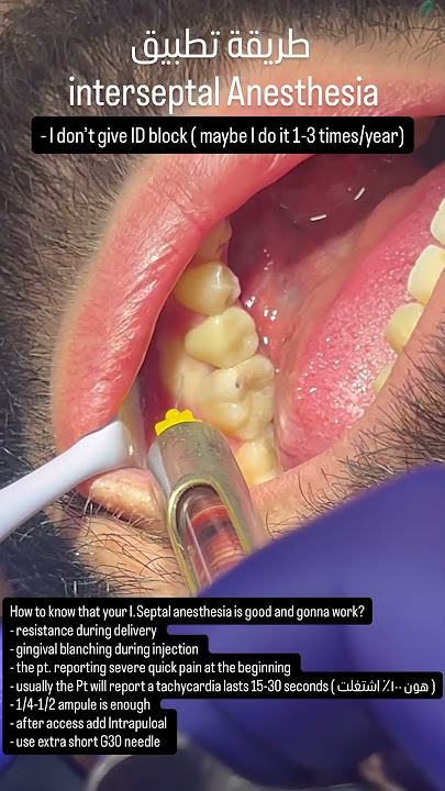 Interseptal Anesthesia
