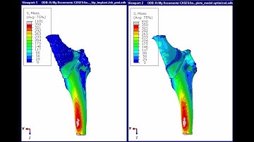 Optimization of hip implant done with SIMULIA Abaqus & Tosca