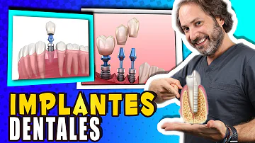 ¿Cuántos dientes se pueden poner en un implante?