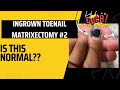 Is this normal help ingrown toenail matrixectomy