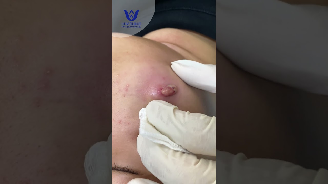 Nặn mụn mủ sưng viêm to ở má.