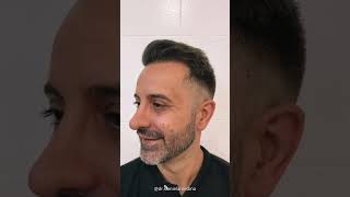 Antes Y Después De Un Injerto Capilar