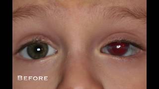 Custom Color Contacts -  BEFORE and AFTER Prosthetic PHOTOS www.customcontacts.com screenshot 2