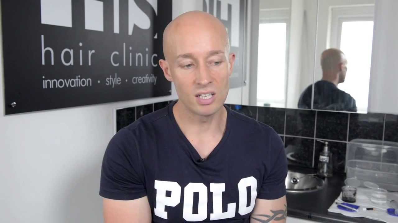 Scalp MicroPigmentation Birmingham Brian's Hair Loss Story YouTube