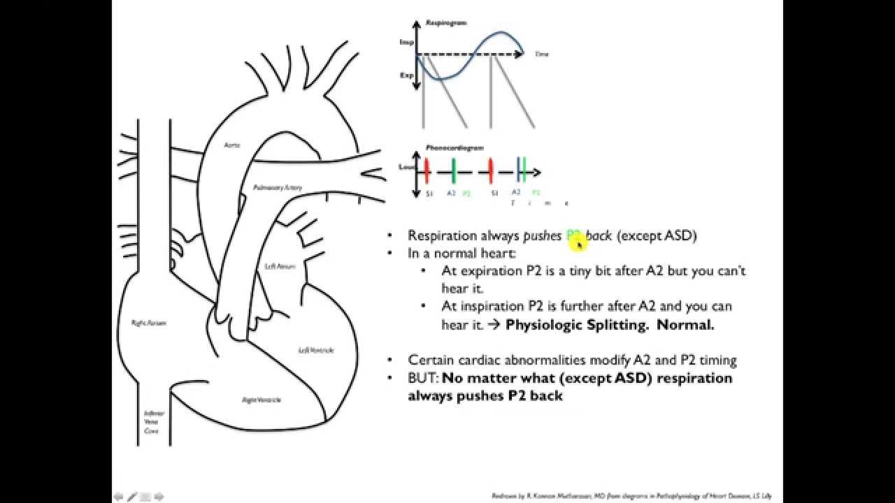 Splitting Of The Second Heart Sound S2 YouTube splitting-of-the-second-heart-sound-s2-youtube