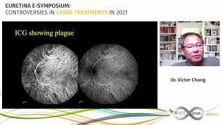 EURETINA 2021 - CONTROVERSIES IN LASER TREATMENTS IN 2021