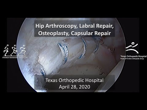 Hip Arthroscopy, Labral Repair, Femoral Osteoplasty for Hip Impingement (CAM and Pincer type FAI)