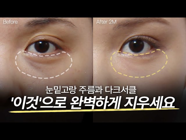 성형외과 의사가 추천하는 눈밑지 찰떡궁합 시술 TOP 2