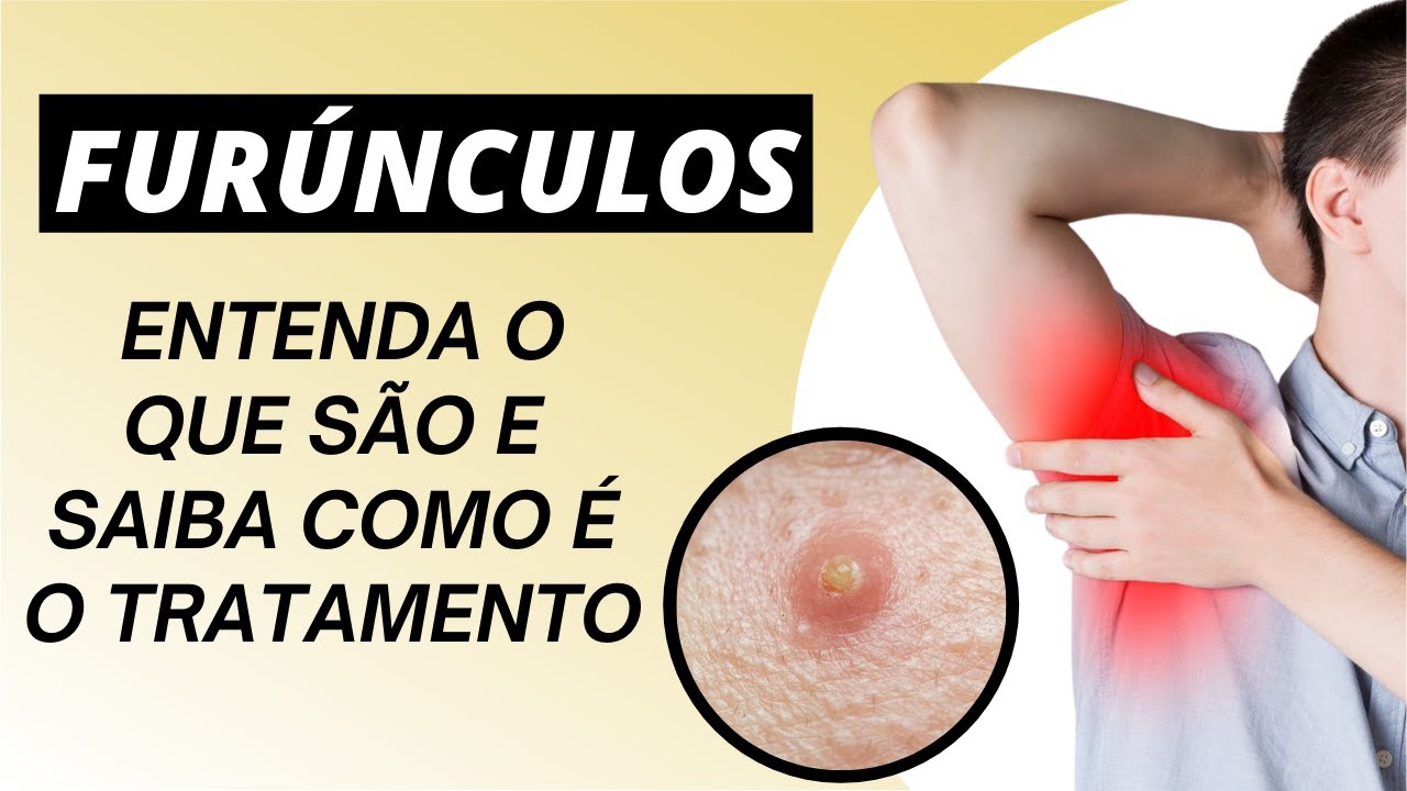 Furúnculos - entenda o que são e como é o tratamento - YouTube