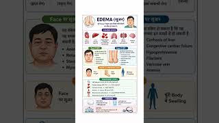 Edema (सूजन) Causes, Symptoms &amp; Treatment | #medical #health #nursing #medicine #mbbs #education