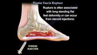 walking boot for plantar fascia tear