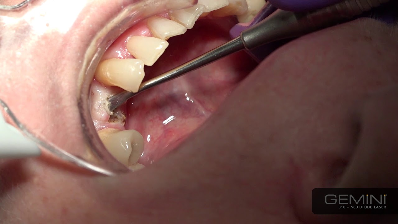 How To Use the Gemini Laser Uncovering Implants YouTube