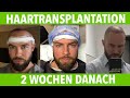 Meine Haartransplantation bei Elithairtransplant in Istanbul 👦 2 Wochen danach