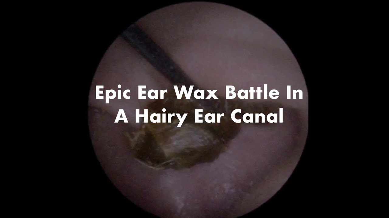 Epic Ear Wax Removal In Hairy Ear Canal Ep 10 YouTube