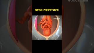 Breech Presentation: Understanding and Managing the Upside-Down Baby